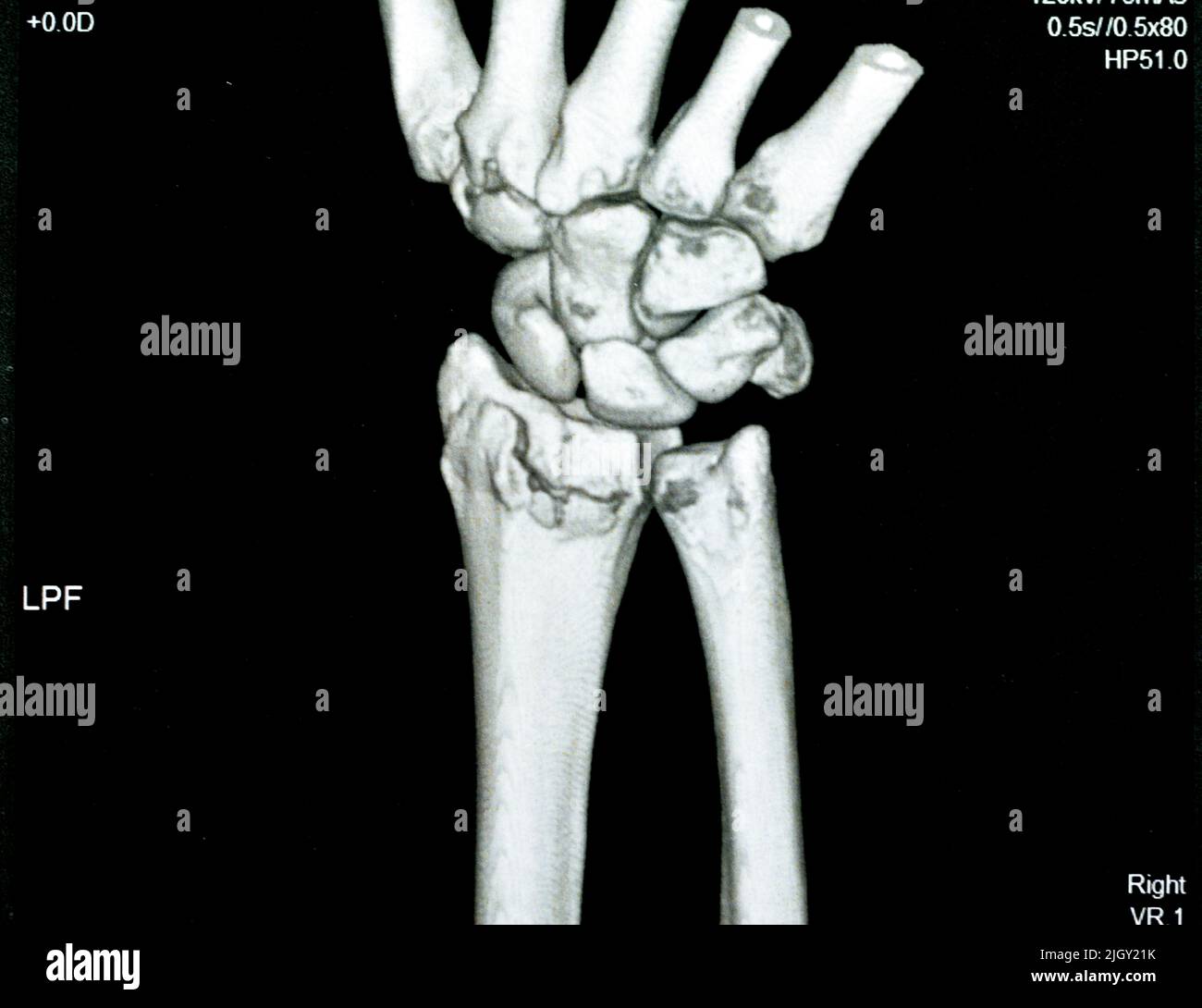 La vue 3D de l'articulation du poignet droit de l'acquisition CT montre une fracture du rayon distal droit pour une réduction fermée et un foyer sélectif moulé d'une imagerie d'acquisition CAT montrant la fracturation Banque D'Images