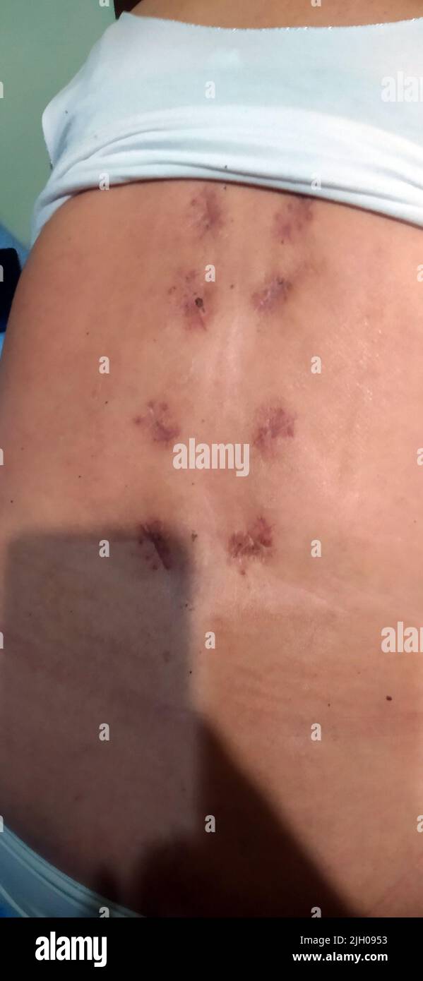 dos sur lequel il y a des cicatrices symétriques de huit trous par couple montant ops sur le support lombaire dorsal sur le corps d'une femme Banque D'Images