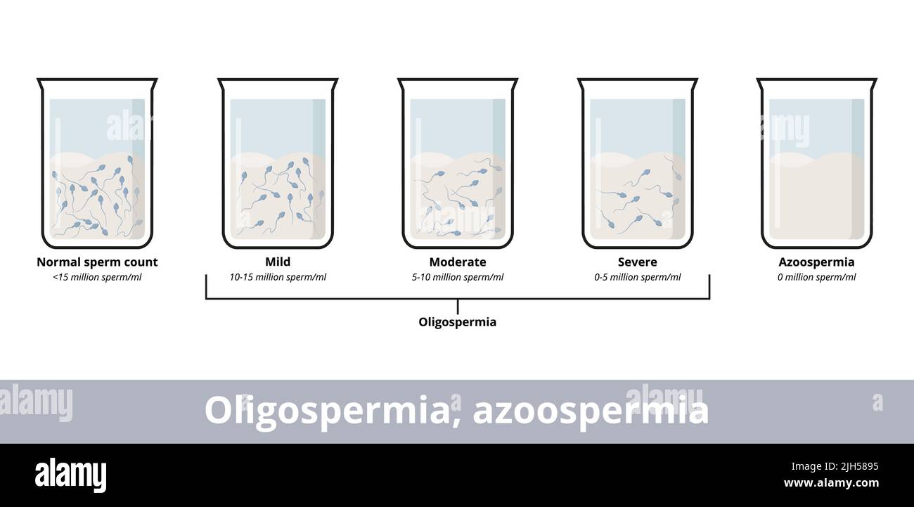 Oligospermie, azoospermie. Visualisation de la numération des spermatozoïdes qui définit l