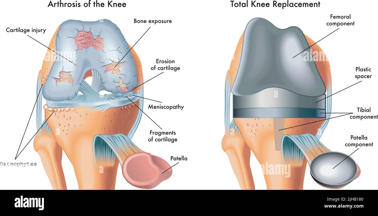 L'illustration médicale montre une arthrose du genou et un remplacement total du genou, avec des annotations. Illustration de Vecteur
