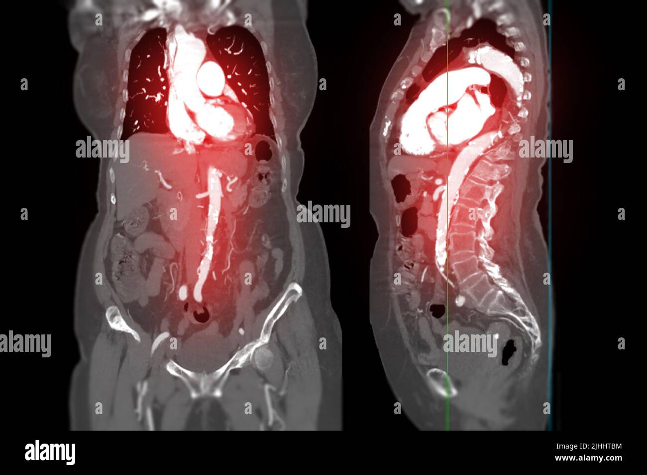 CTA Ante Aorta montrant l'image des artères dans l'ensemble du corps comparer les vues coronales et sagittales générées à partir du scanner CT Banque D'Images
