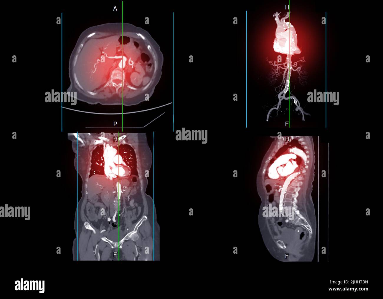 CTA Aorta entière montrant l'image des artères dans l'ensemble du corps générée à partir du scanner CT Banque D'Images
