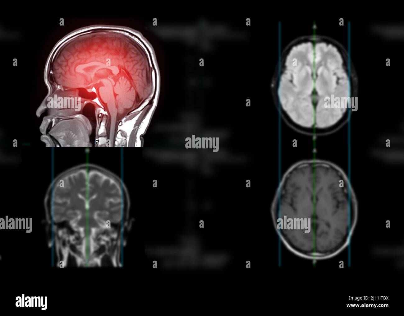 IRM cerveau axial T1W plan pour détecter la maladie d'accident vasculaire cérébral et tumeurs et kystes du cerveau. Banque D'Images