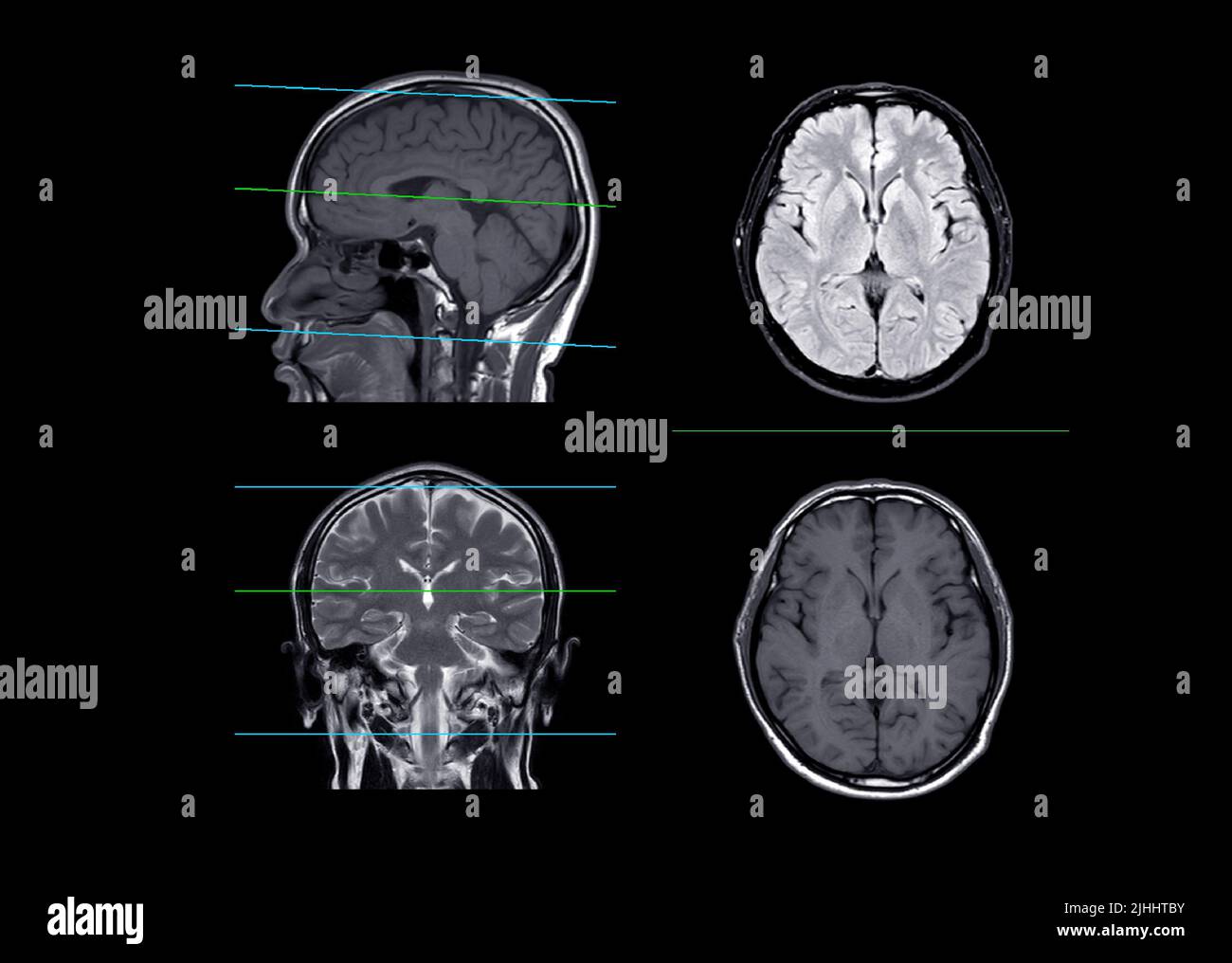 IRM Brain compare les plans axial, frontal et sagittal pour détecter les accidents vasculaires cérébraux et les tumeurs et kystes du cerveau. Banque D'Images