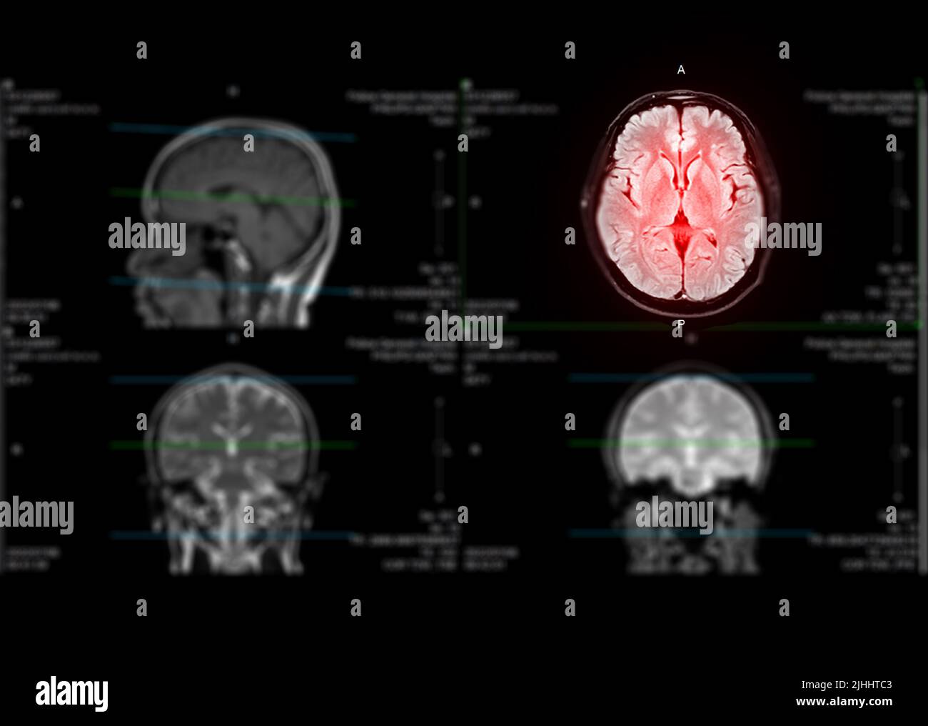 IRM cerveau axial flair pour détecter la maladie d'accident vasculaire cérébral et les tumeurs et les kystes du cerveau. Banque D'Images