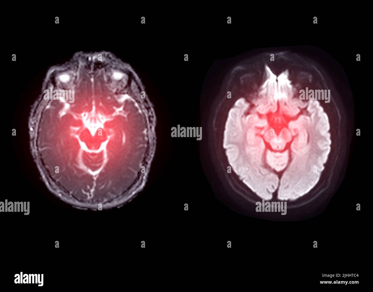 Image de diffusion axiale du cerveau IRM pour détecter les accidents vasculaires cérébraux et les tumeurs et kystes du cerveau. Banque D'Images