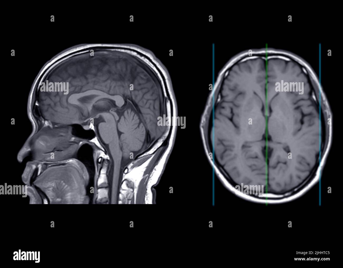 IRM cerveau axial T1W plans vue sagittale et axiale pour détecter la maladie d'accident vasculaire cérébral et tumeurs et kystes du cerveau. Banque D'Images