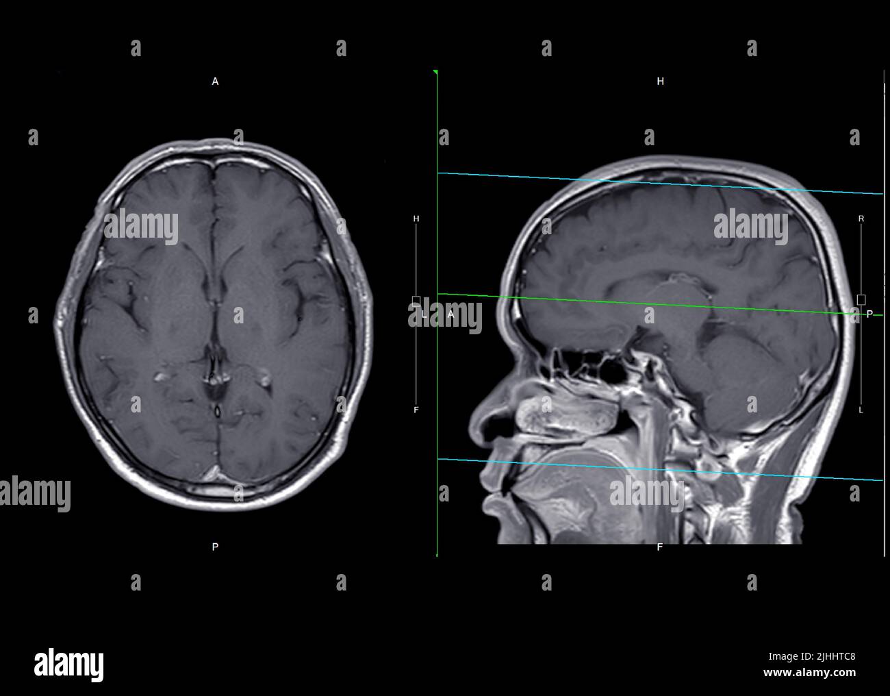 Plan axial et sagittal du cerveau IRM avec contraste de gadolinium pour détecter les accidents vasculaires cérébraux et les tumeurs et kystes du cerveau. Banque D'Images