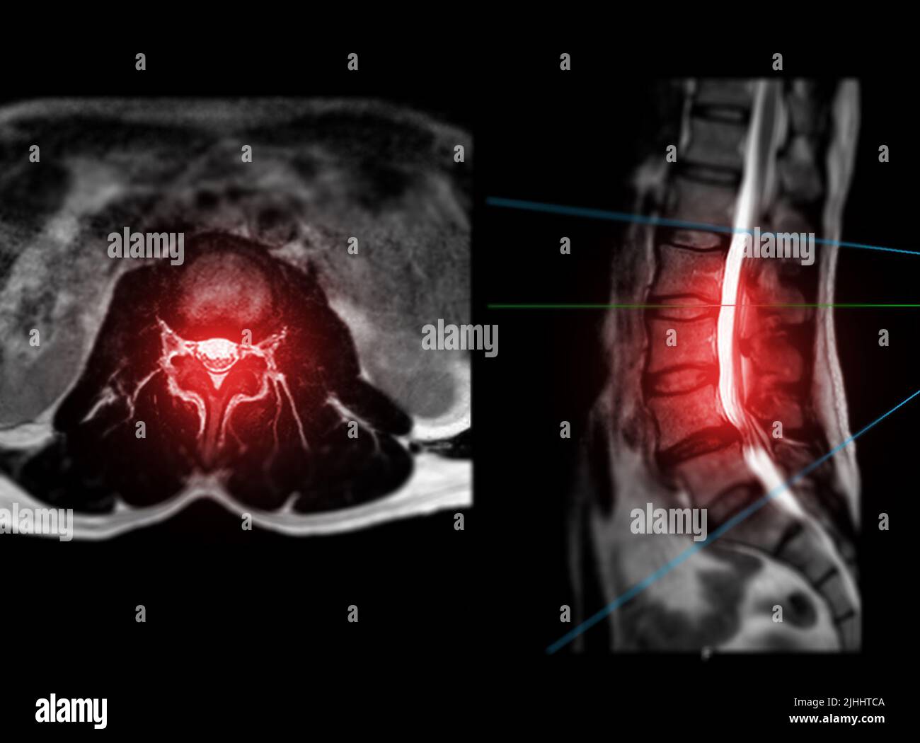 IRM rachis lombaire ou rachis lombaire vue axiale T2W avec plan sagittal pour le diagnostic de la compression de la moelle épinière. Banque D'Images