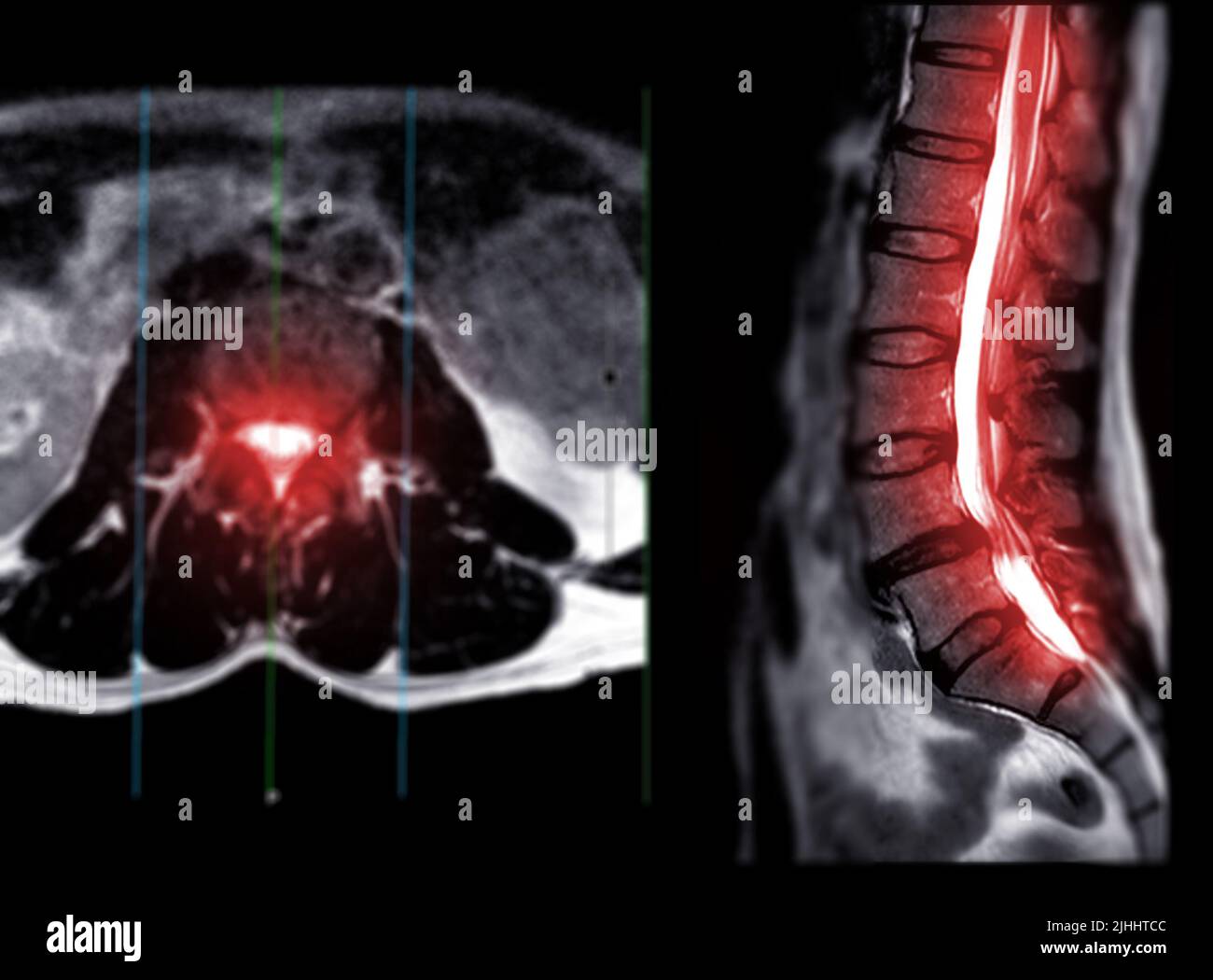 IRM rachis lombaire ou rachis lombaire vue axiale T2W avec plan sagittal pour le diagnostic de la compression de la moelle épinière. Banque D'Images