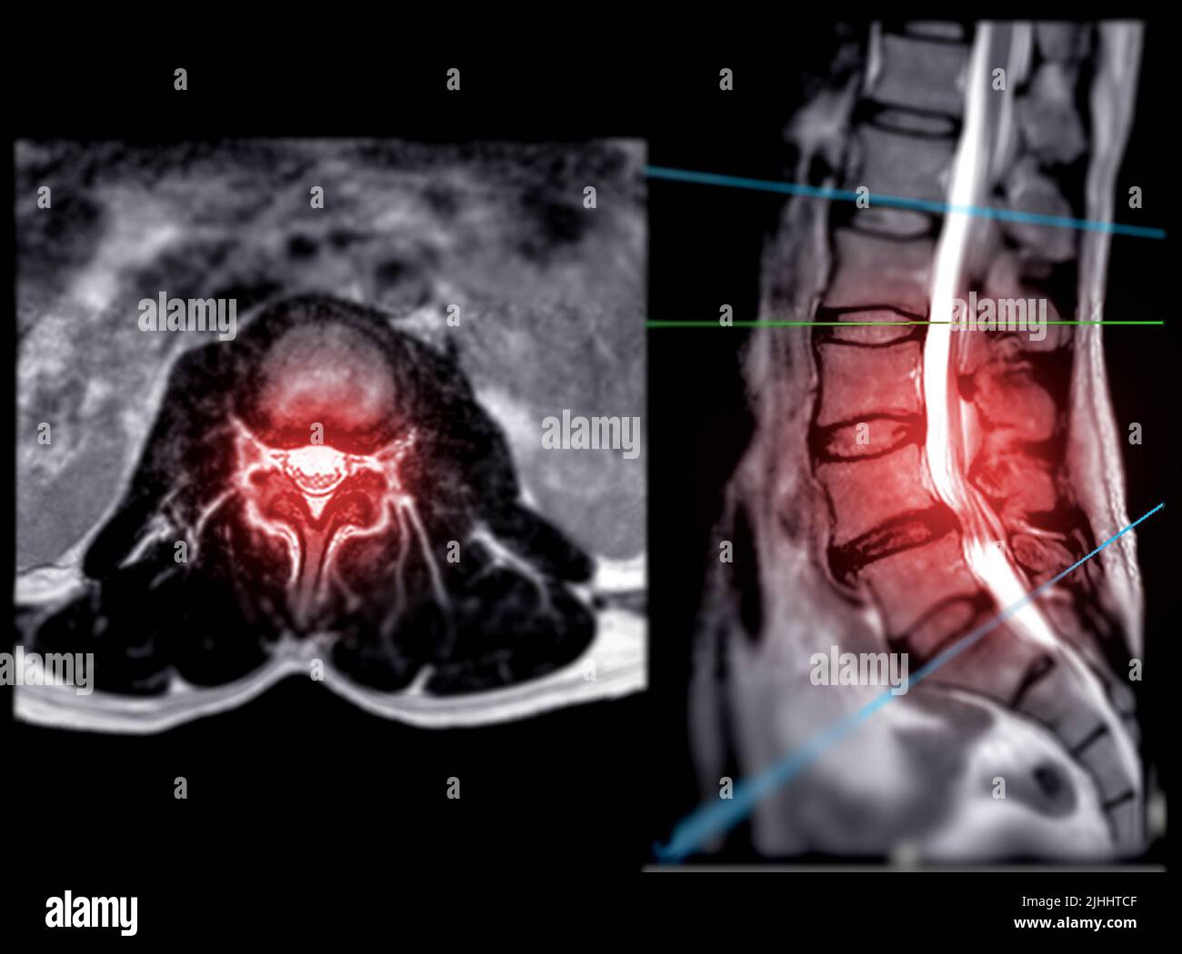 IRM rachis lombaire ou rachis lombaire vue axiale T2W avec plan sagittal pour le diagnostic de la compression de la moelle épinière. Banque D'Images