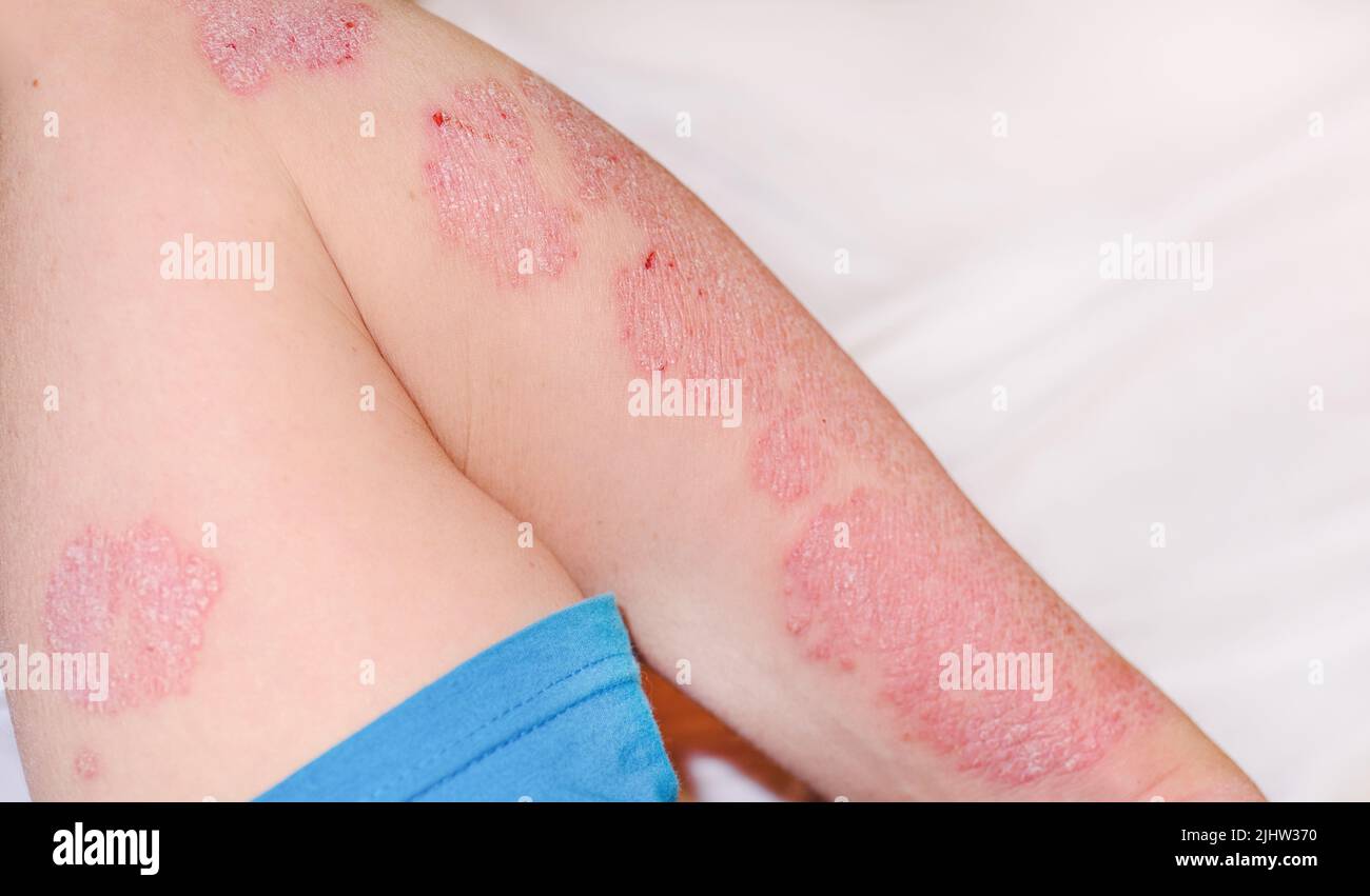 Grande éruption cutanée rouge enflammée et squameuse sur les mains. Psoriasis aigu sur le bras d'un homme, rougeur sévère sur la peau, une maladie incurable auto-immune dermatologique Banque D'Images Grande éruption cutanée rouge enflammée et squameuse sur les mains. Psoriasis aigu sur le bras d'un homme, rougeur sévère sur la peau, une maladie incurable auto-immune dermatologique Banque D'Images