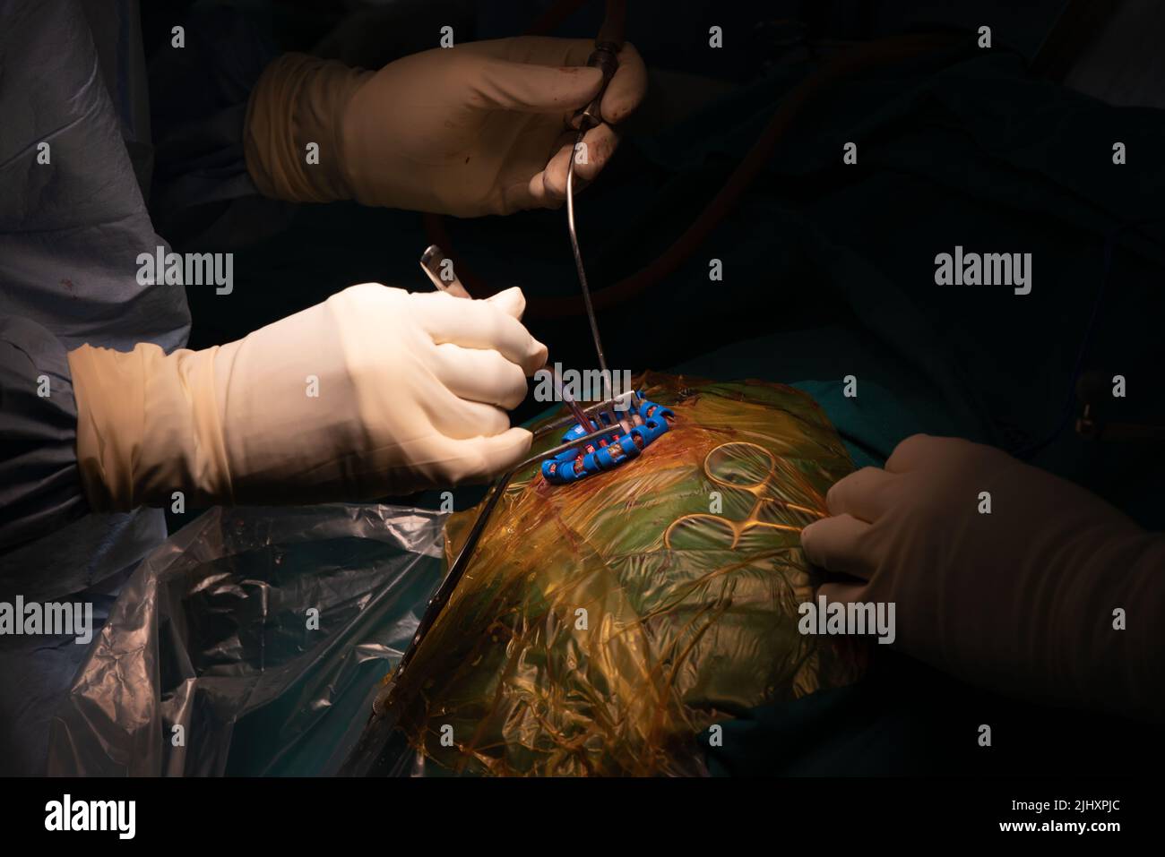Neurochirurgien effectuant une chirurgie du cerveau en salle d'opération Banque D'Images