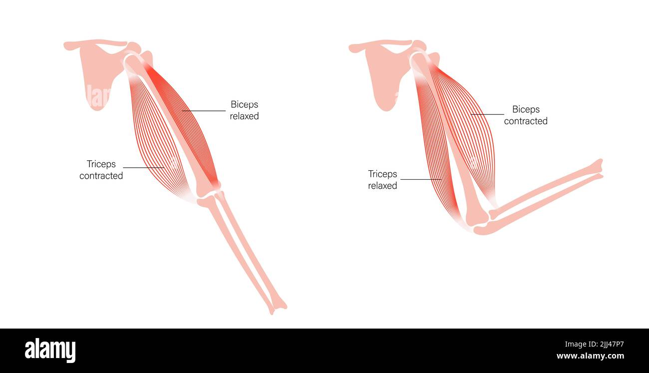 Dystrophie musculaire, illustration. Banque D'Images