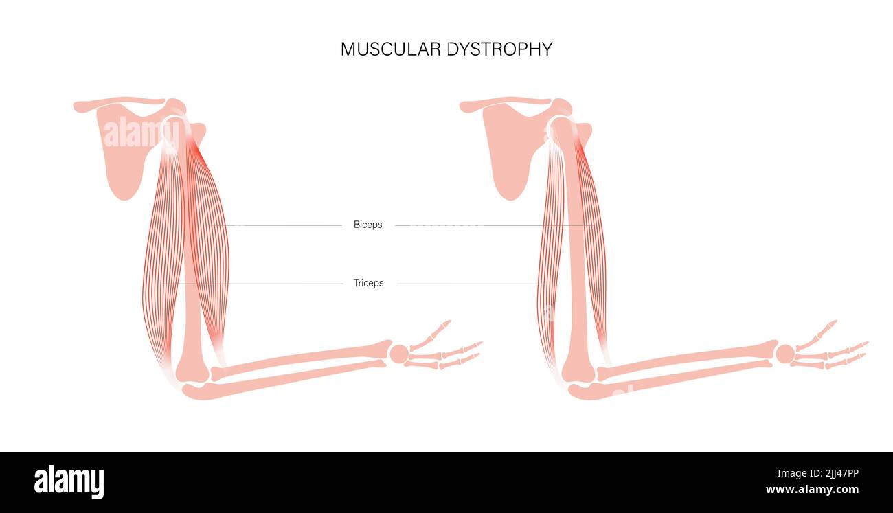 Dystrophie musculaire, illustration. Banque D'Images