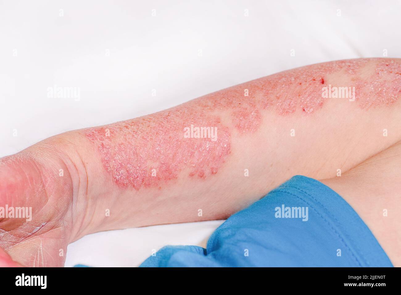 Psoriasis aigu sur le bras d'un homme, rougeur sévère sur la peau, maladie dermatologique incurable auto-immune. Grande éruption cutanée rouge enflammée squameuse activée Banque D'Images Psoriasis aigu sur le bras d'un homme, rougeur sévère sur la peau, maladie dermatologique incurable auto-immune. Grande éruption cutanée rouge enflammée squameuse activée Banque D'Images