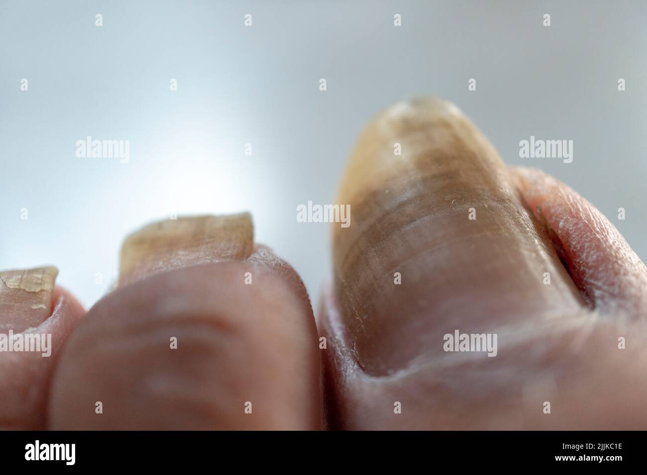 Un gros plan d'un ongle long et sale de la jambe gauche. Banque D'Images
