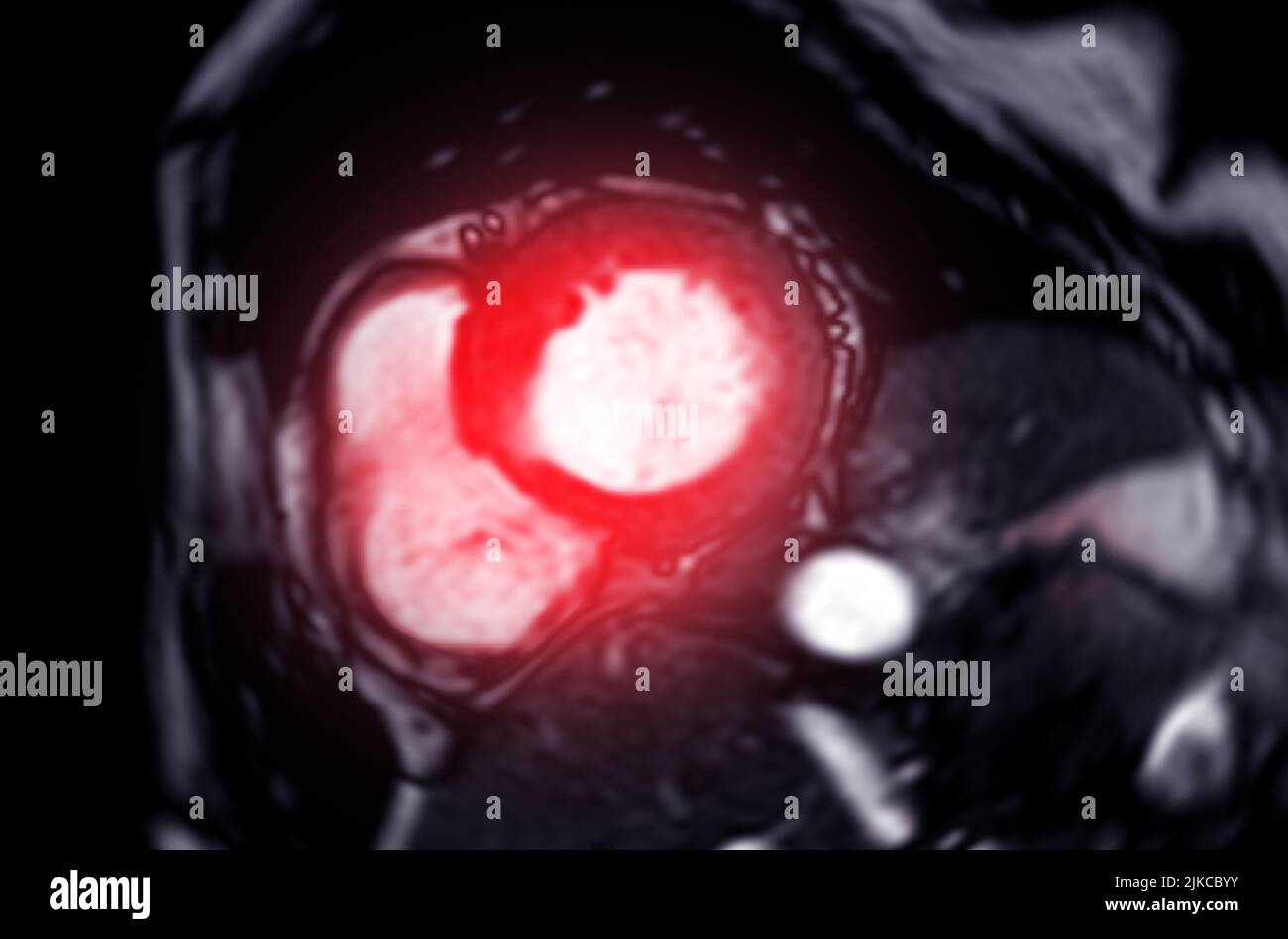 IRM cardiaque ou cardiaque IRM (imagerie par résonance magnétique) du cœur dans une vue à axe court montrant le plan de battement cardiaque pour détecter une maladie cardiaque. Banque D'Images