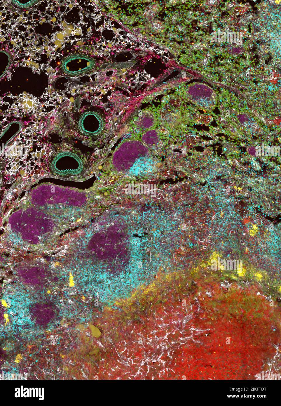 Cette image confocale montre un ganglion lymphatique avec un abcès, rempli de CD11b+ cellules myéloïdes (rouges), entouré de dépôts de collagène (blanc). Banque D'Images