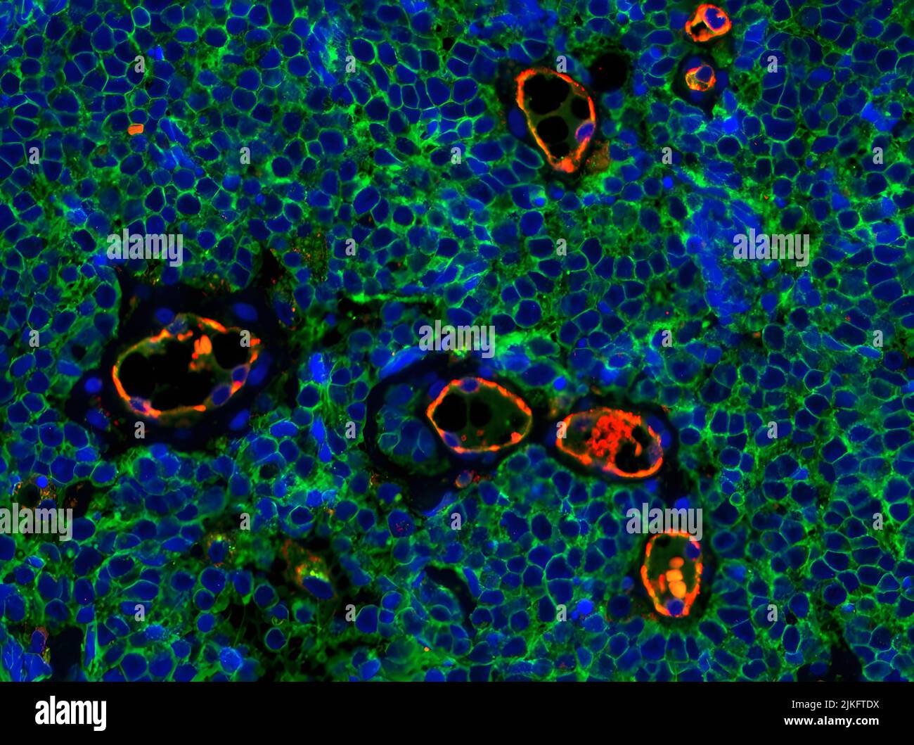 Coloration par immunofluorescence du carcinome à cellules de Merkel tissu tumoral illustrant l'expression de CD200 (vert) à la surface des cellules tumorales. CD200 joue un rôle dans l'immunosuppression. Le marqueur endothélial CD31 (rouge) met en évidence les vaisseaux sanguins. Le carcinome cellulaire de Merkel est un cancer de la peau rare et agressif. Banque D'Images