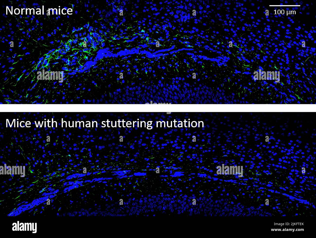 Dans un modèle de souris de stuttering (panneau inférieur), il y a moins d'astrocytes, affichés en vert, par rapport aux contrôles (panneau supérieur) dans le corps callosum, la zone du cerveau qui permet aux hémisphères gauche et droit de communiquer. Banque D'Images