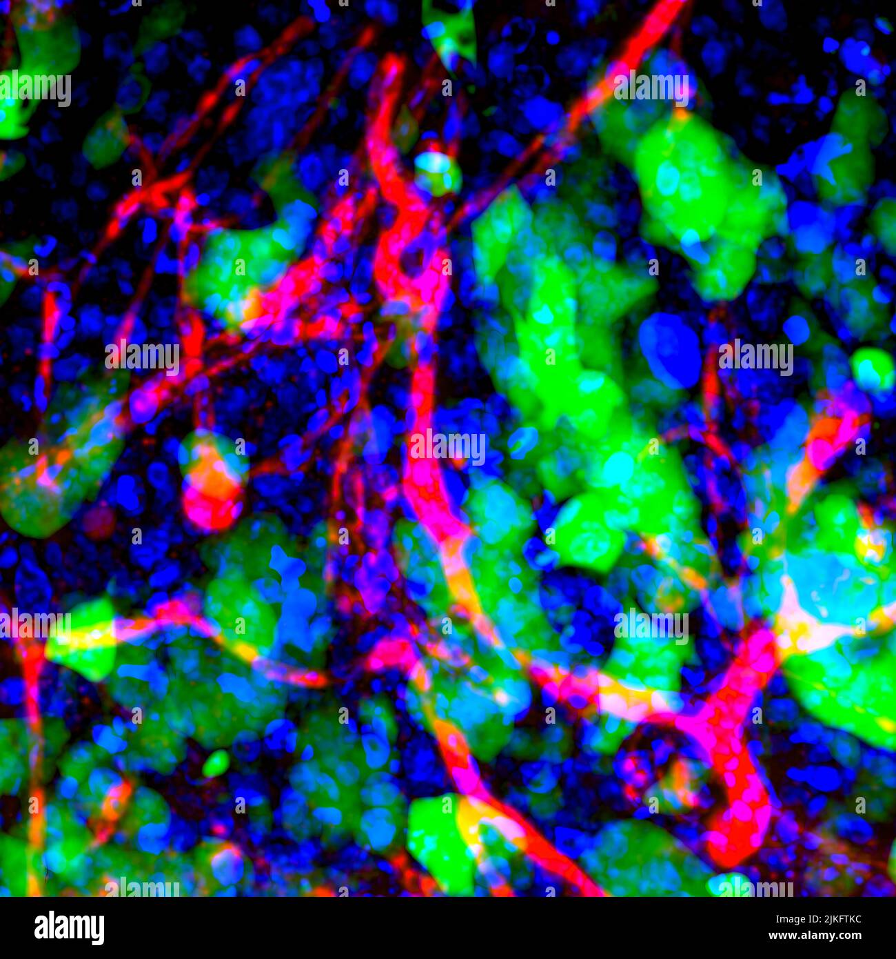 Le cancer qui s'est propagé (métastasé) au cerveau est normalement incurable parce que la barrière protectrice sang-cerveau empêche la plupart des traitements d'entrer. Les nanoparticules capables de transporter des médicaments et de franchir la barrière peuvent aider à administrer des thérapies salvantes à ces tumeurs. Cette image montre les vaisseaux sanguins (rouge), les noyaux cellulaires (bleu) et les cellules métastatiques du cancer du sein humain (vert) dans le cerveau d'une souris, après administration intraveineuse de nanoparticules expérimentales capables de traverser la barrière sang-cerveau. Banque D'Images