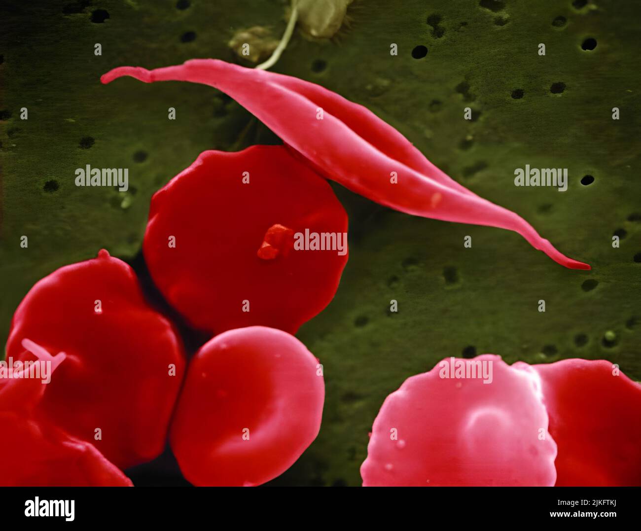 La drépanocytose est une maladie génétique du sang qui endommage les globules rouges. La maladie touche des millions de personnes dans le monde entier et environ 80 000 patients aux États-Unis, en particulier une naissance afro-américaine sur 500. Un défaut dans l'hémoglobine (une protéine qui aide les cellules à transporter l'oxygène à travers le corps) causant des globules rouges à devenir raides et en forme de croissant (faucille), bloquant les petits vaisseaux sanguins et causant une diminution du flux sanguin, inflammation, douleur et accidents vasculaires cérébraux. Enfants. Banque D'Images