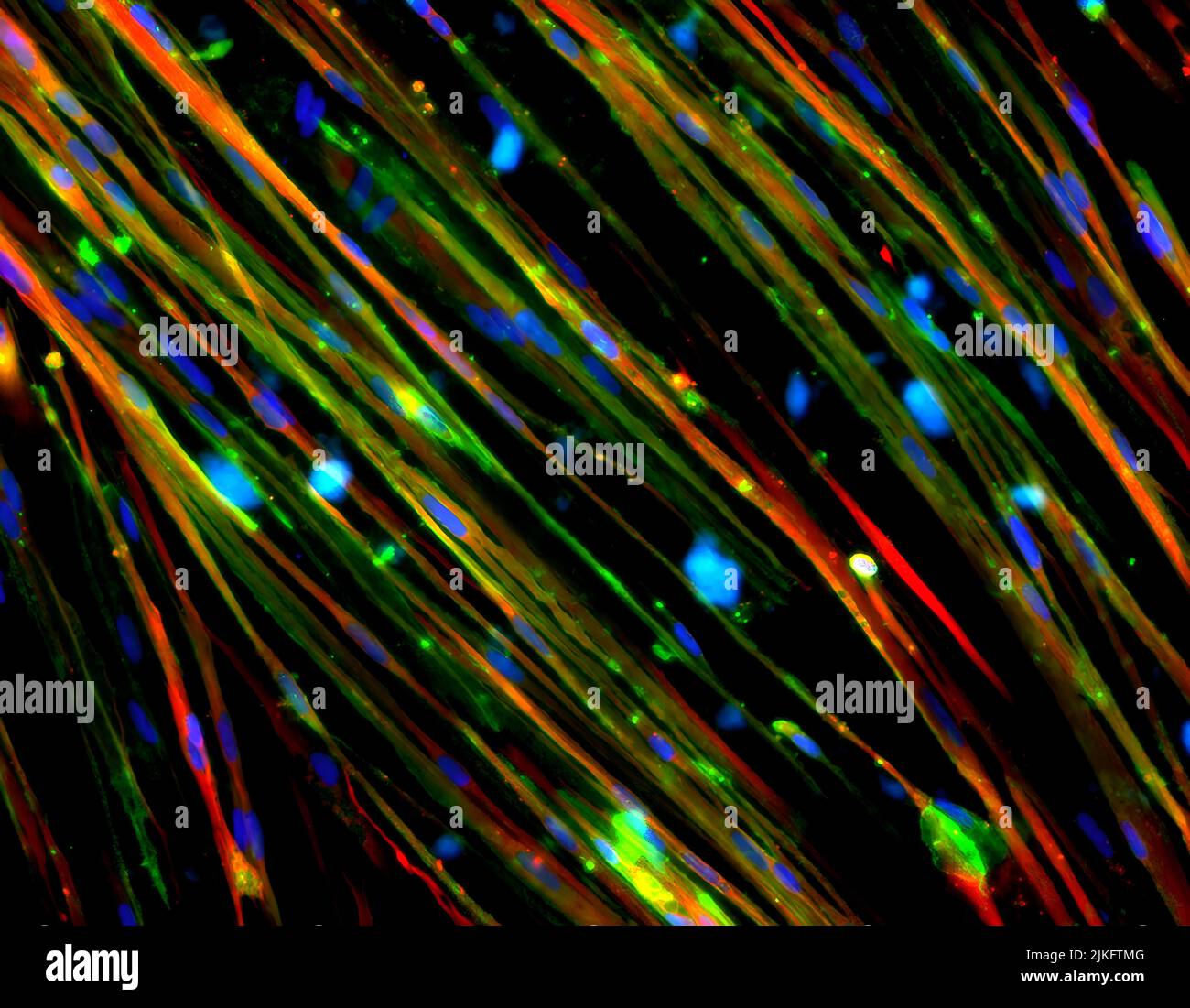 Cette image montre la restauration de la dystrophine (vert coloré) dans les cellules musculaires de la dystrophie musculaire de Duchenne (DMD) dérivées de cellules souches pluripotentes induites par l'homme. La DMD est causée par des mutations dans le gène de la DMD qui affectent la production de la dystrophine, une protéine impliquée dans la structure de la membrane des cellules musculaires. Les chercheurs ont utilisé la technologie d'édition de gènes CRISPR/Cas9 pour corriger une mutation, ce qui a entraîné la restauration de la dystrophine. Cette technologie pourrait être thérapeutique dans jusqu'à 60 % des mutations de patients atteints de DMD. Les noyaux des cellules musculaires sont colorés en bleu et la myosine de la protéine contractile est colorée en rouge. Banque D'Images