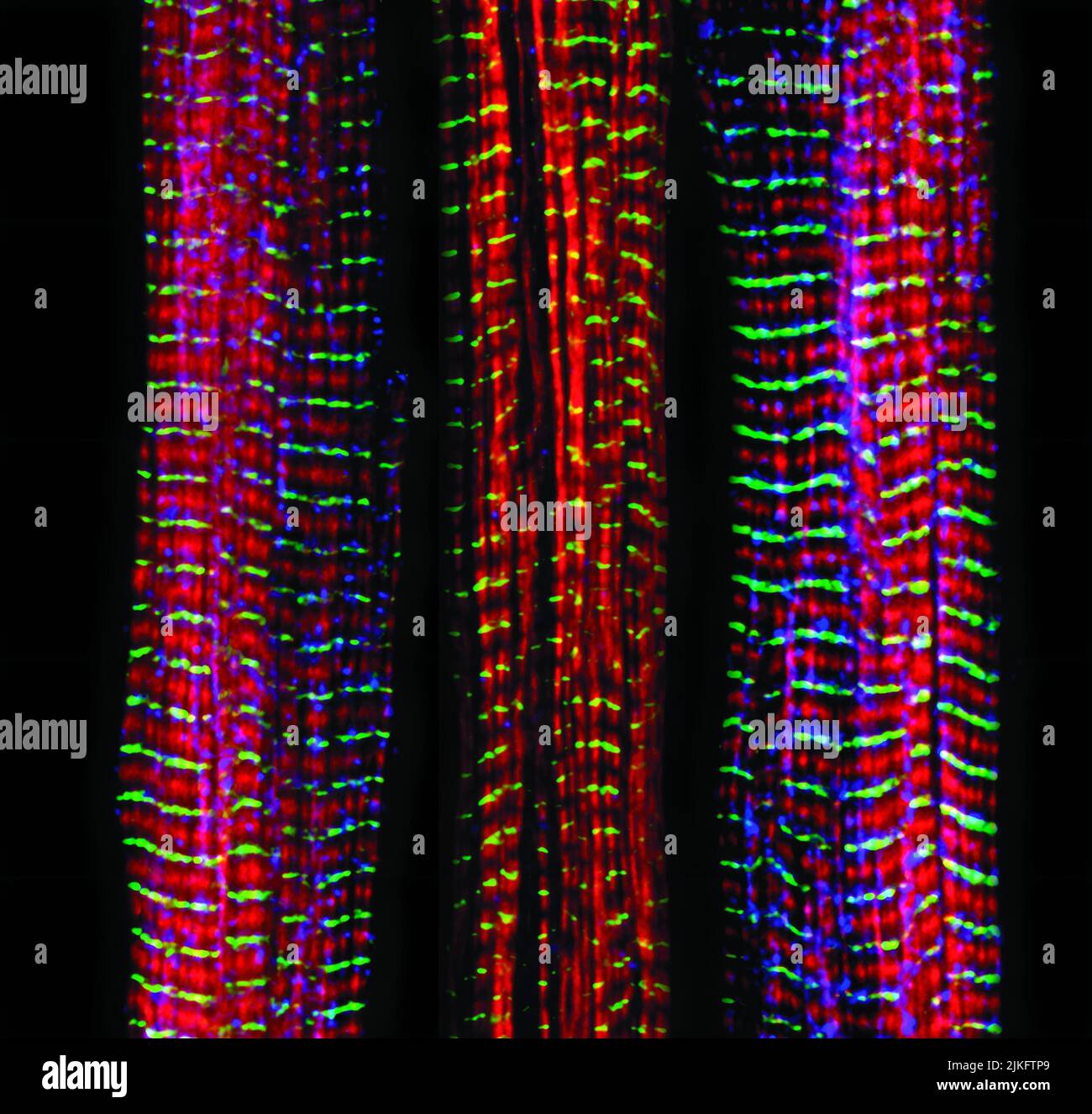 Parmi les trois fibres musculaires illustrées ici, celle de droite et celle de gauche sont normales. La fibre moyenne est déficiente une grande protéine appelée nébuline (bleu). Nebulin joue un certain nombre de rôles dans la structure et la fonction des muscles, et son absence est associée à certains troubles neuromusculaires. Banque D'Images