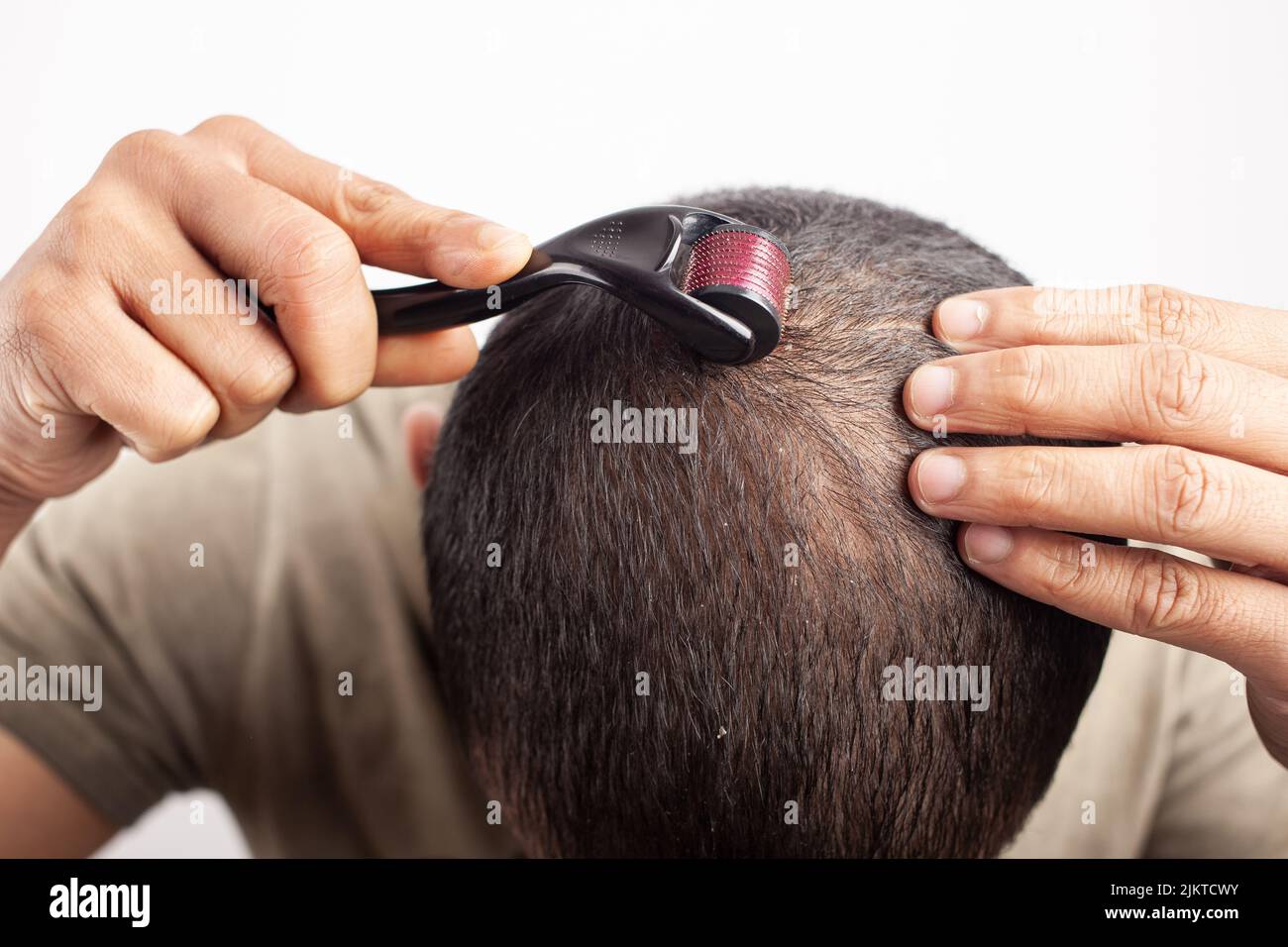 Homme utilisant dermaroller sur les patches chauves pour la croissance des cheveux dans le fond blanc. Banque D'Images