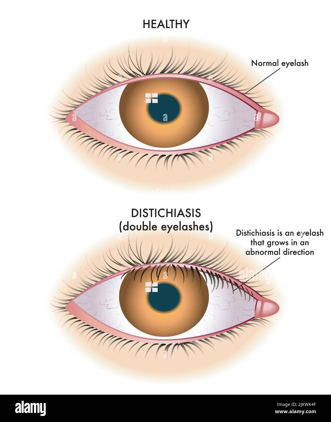 L'illustration médicale montre la comparaison entre un œil normal et un œil affecté par la distichiasis. Banque D'Images