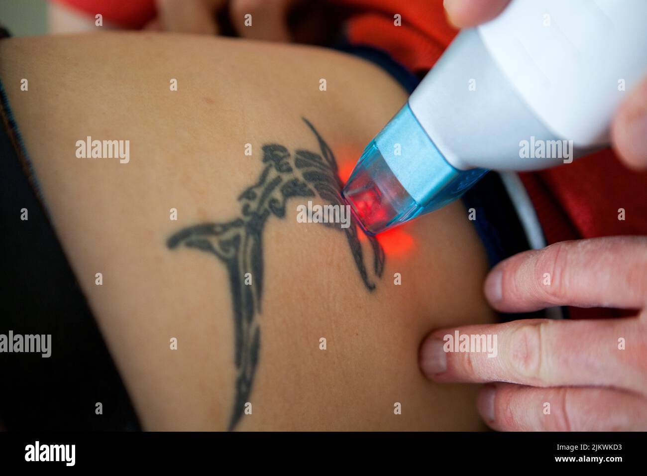 Fraction CO2 séance de tatouage laser dans un salon de beauté. Banque D'Images