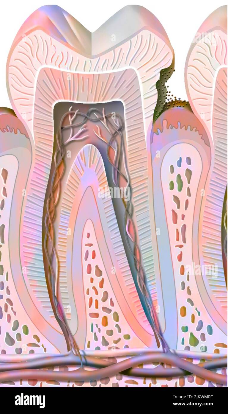 Carie dentaire de premier étage (dommage émaillé). Banque D'Images