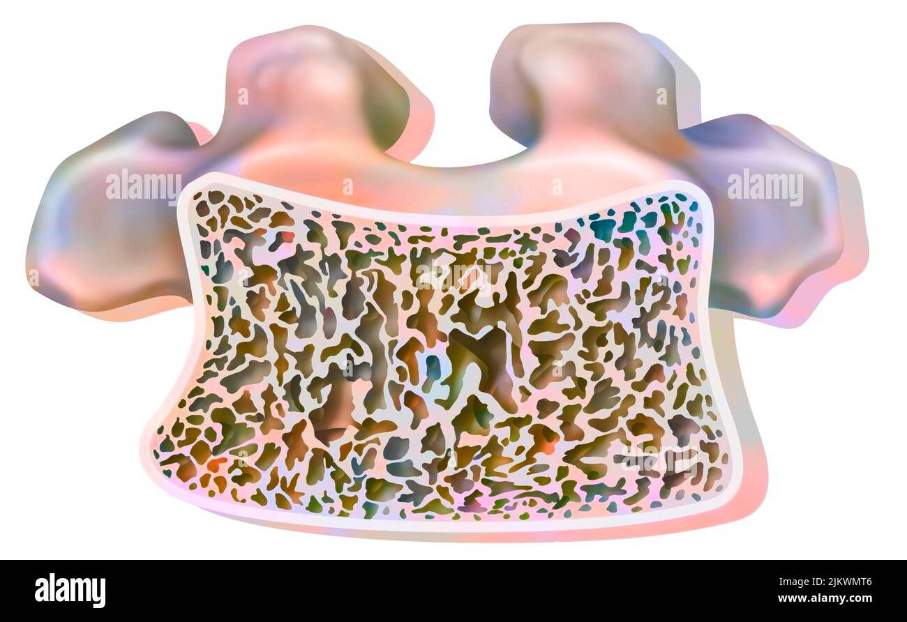 Vertèbres dorsales avec ostéoporose avec tissu spongieux partiellement détruit. Banque D'Images