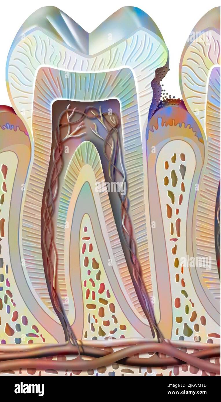 Carie dentaire de premier étage (dommage émaillé). Banque D'Images