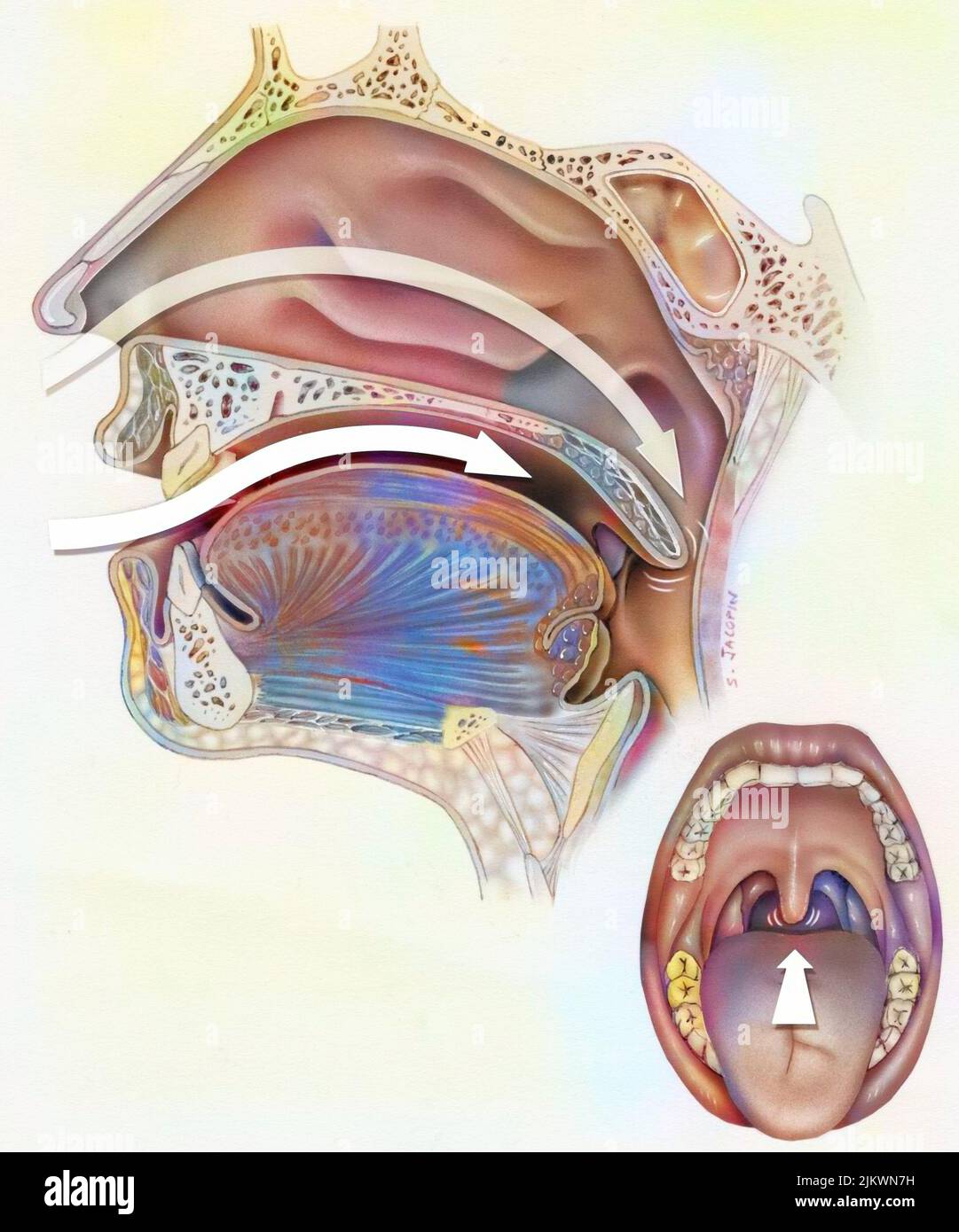 Voies aériennes (nasopharynx) chez les ronfleurs : diminution du tonus musculaire. Banque D'Images