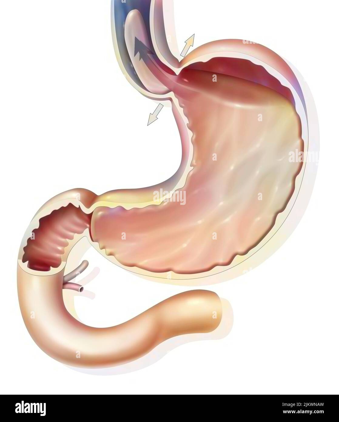 Estomac : reflux gastro-oesophagien dans le sphincter gastro-oesophagien. Banque D'Images