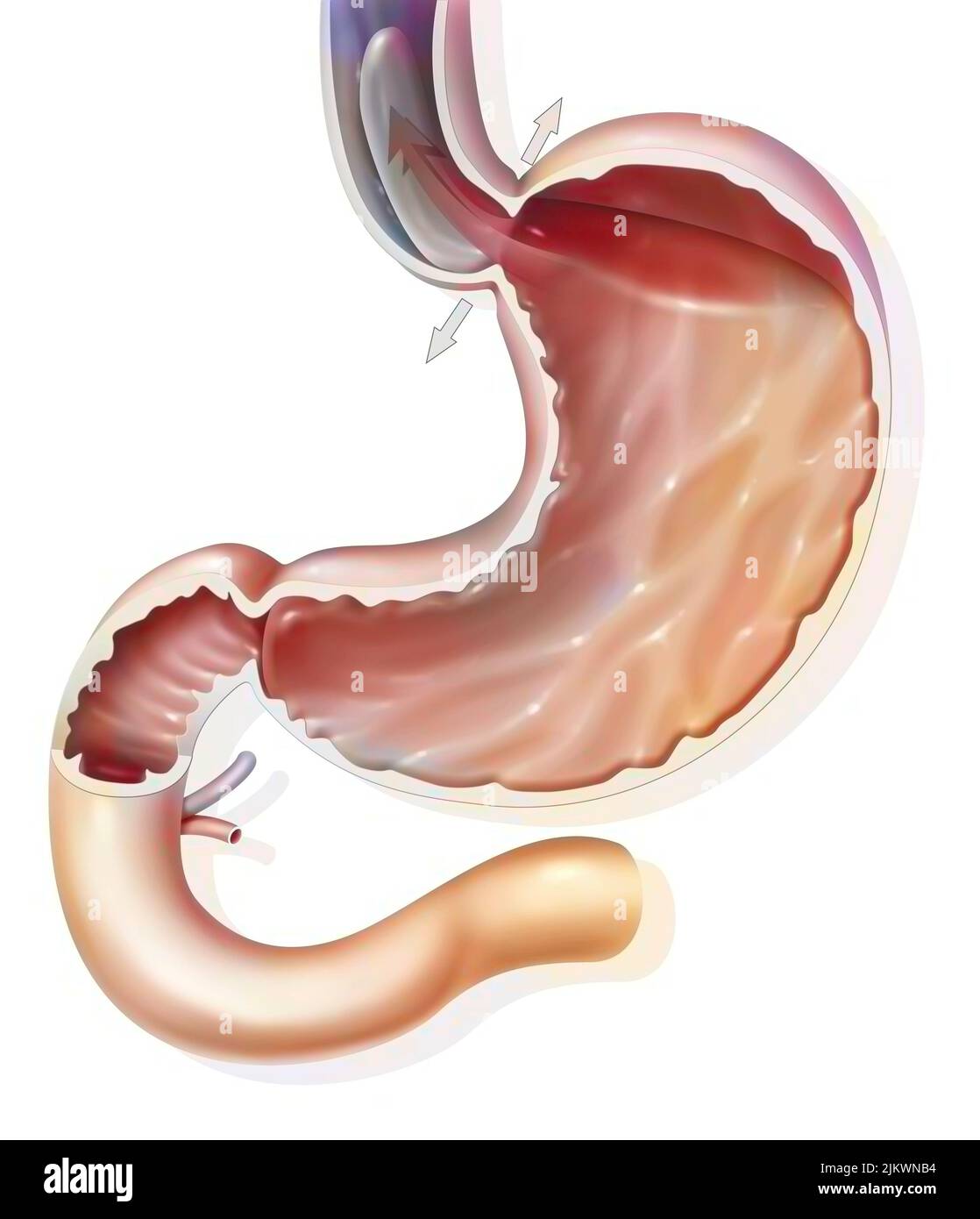 Estomac : reflux gastro-oesophagien dans le sphincter gastro-oesophagien. Banque D'Images
