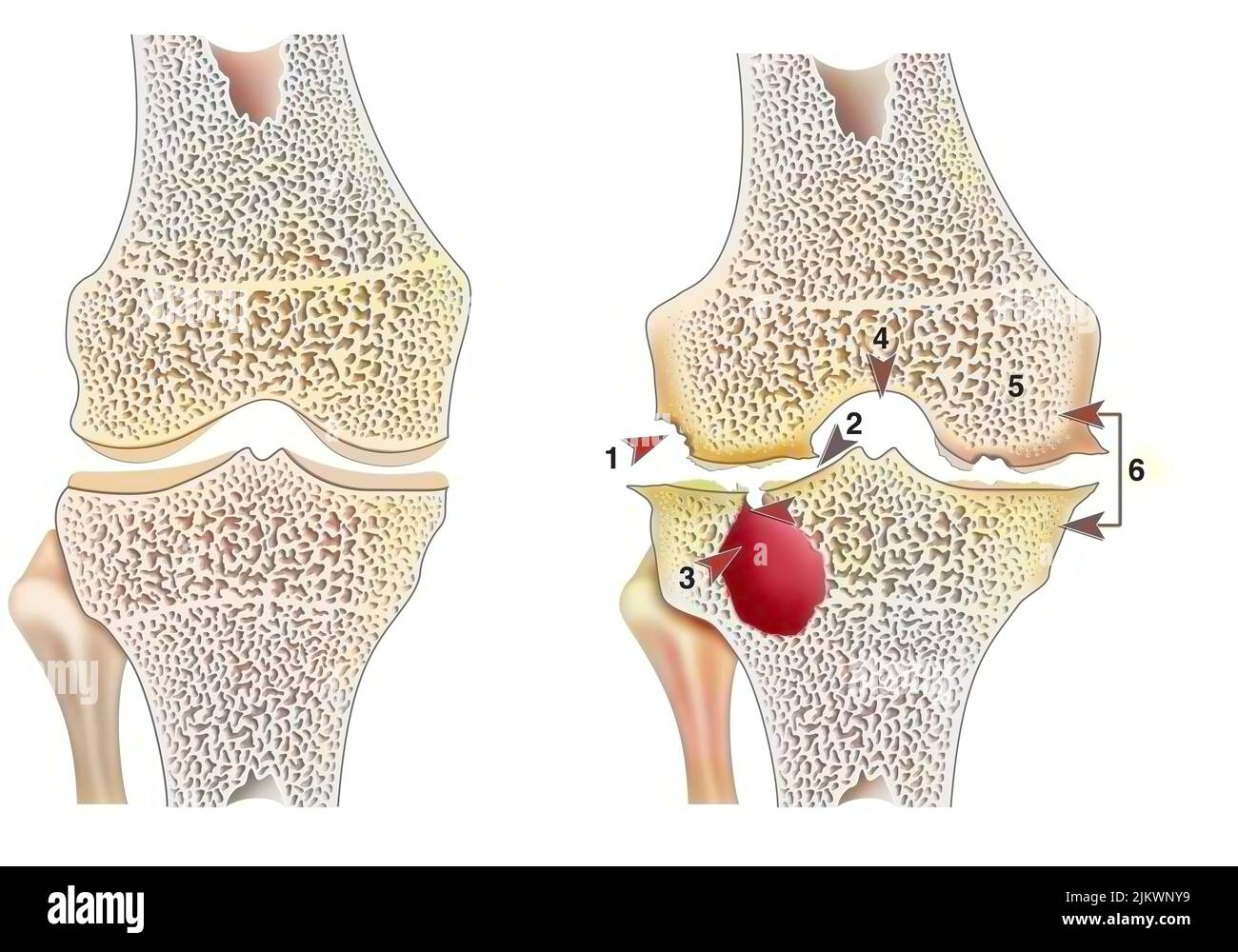 Genou en bonne santé avec arthropathie hémophile lors de la coupe frontale. Banque D'Images