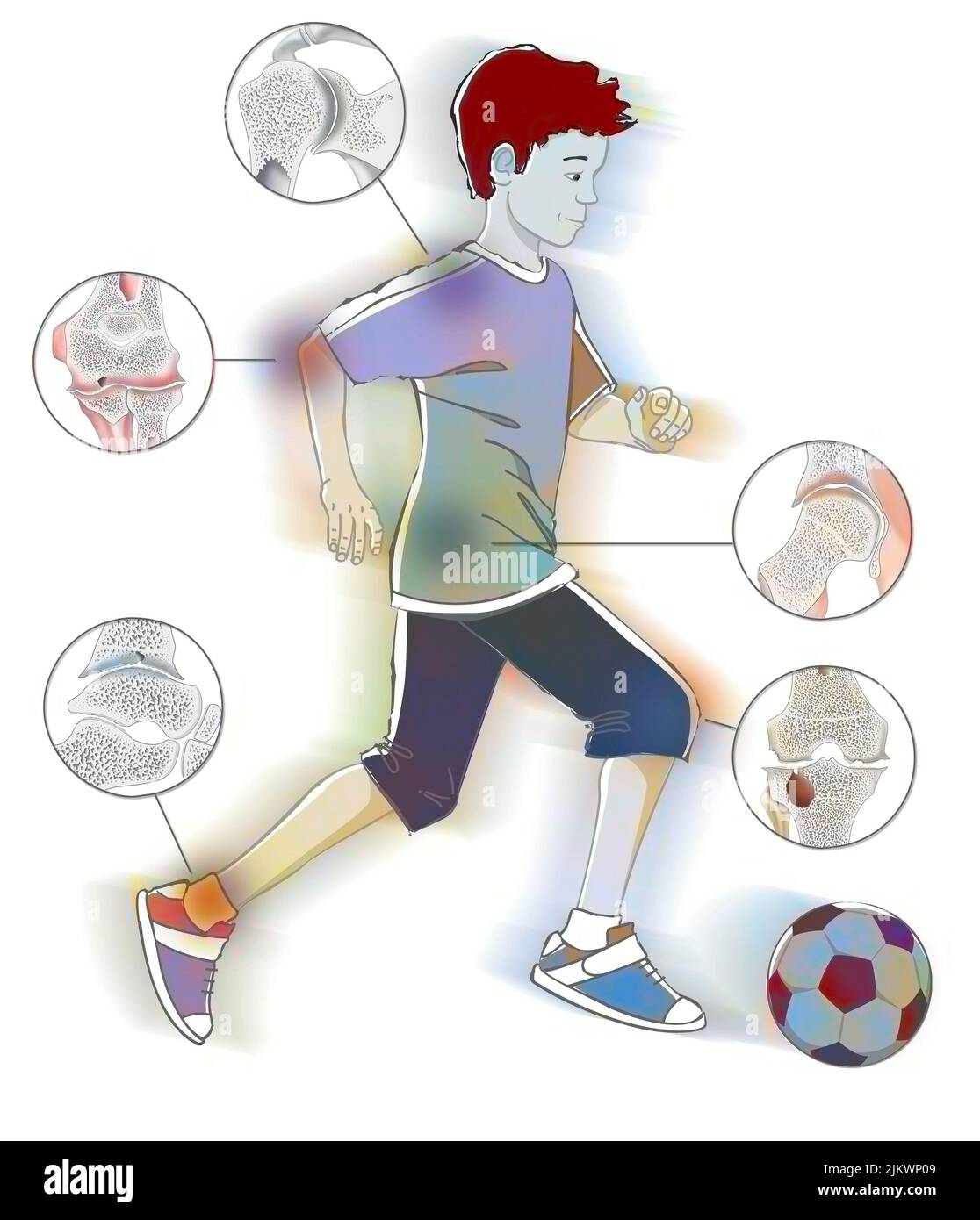 Emplacement des articulations les plus affectées par l'arthropathie hémophile. Banque D'Images