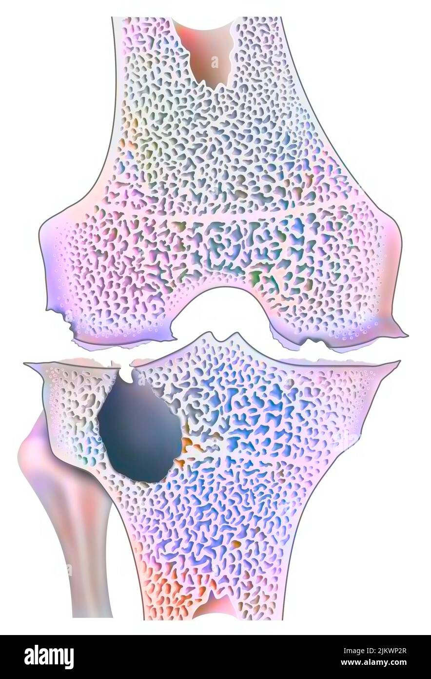 Genou avec arthropathie hémophile avec érosion articulaire marginale. Banque D'Images