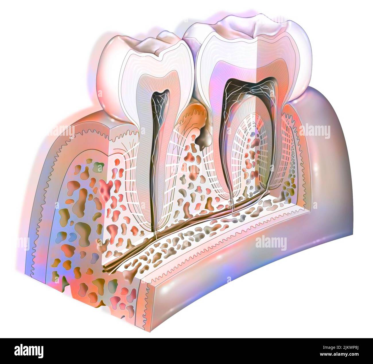 Plaque dentaire: Pathologies principales des dents: Tartre, gingivite. Banque D'Images