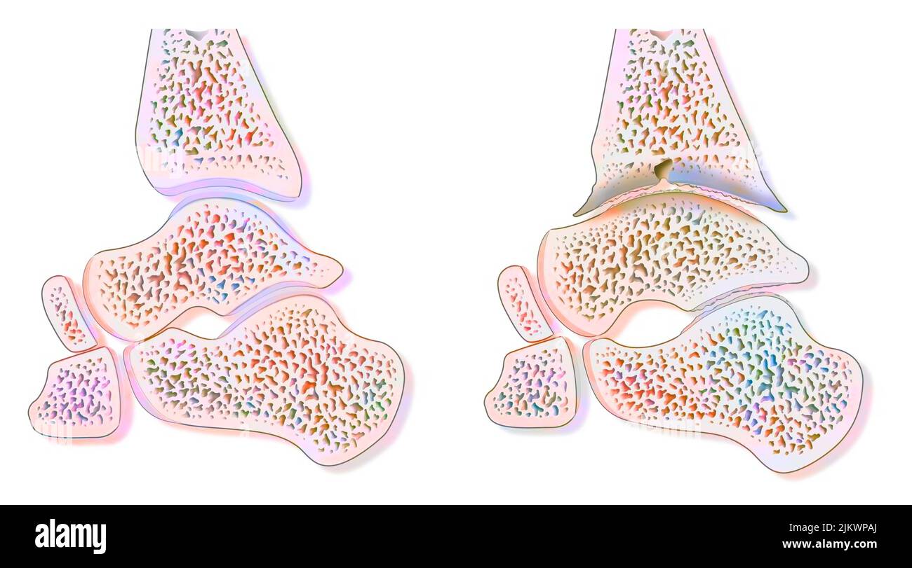 Comparaison entre une cheville saine et une arthropathie hémophile (hémarthrose). Banque D'Images