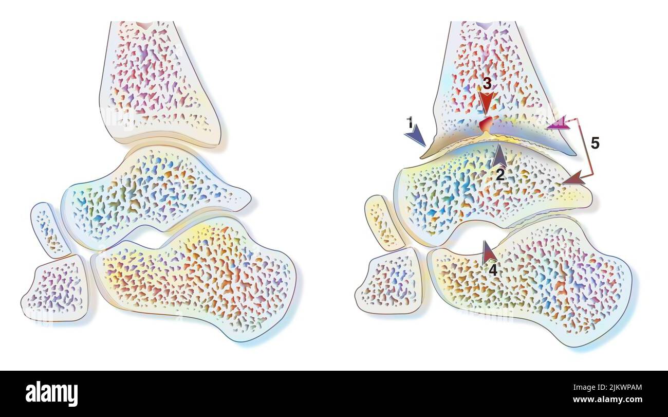 Comparaison entre une cheville saine et une arthropathie hémophile (hémarthrose). Banque D'Images