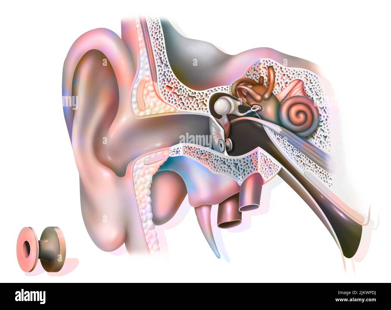 Traitement de l'otite : ventilateur tympanique dans l'oreille pour favoriser la ventilation de l'oreille. Banque D'Images
