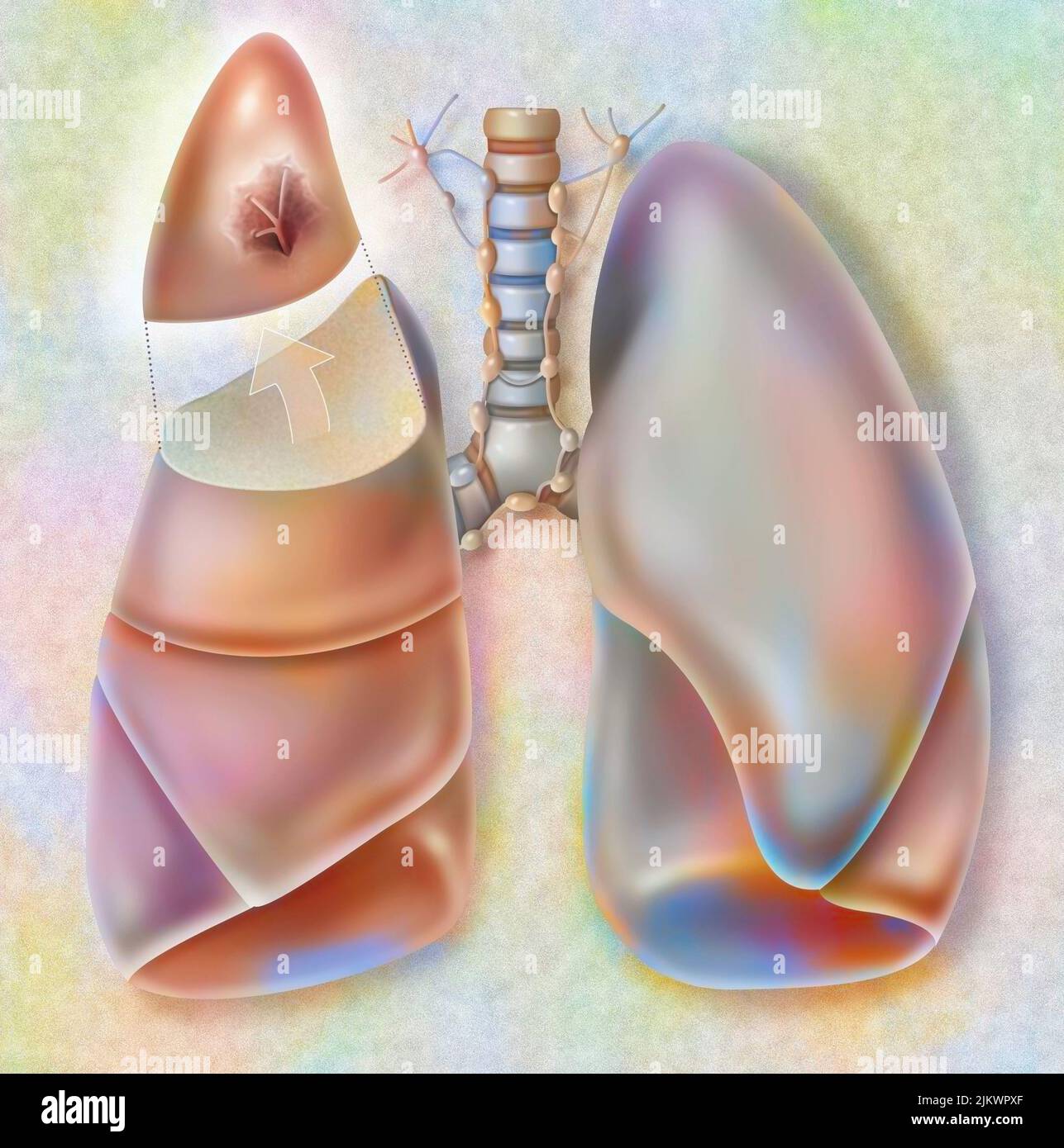 Retrait du segment apical du poumon droit affecté par une tumeur cancéreuse. Banque D'Images