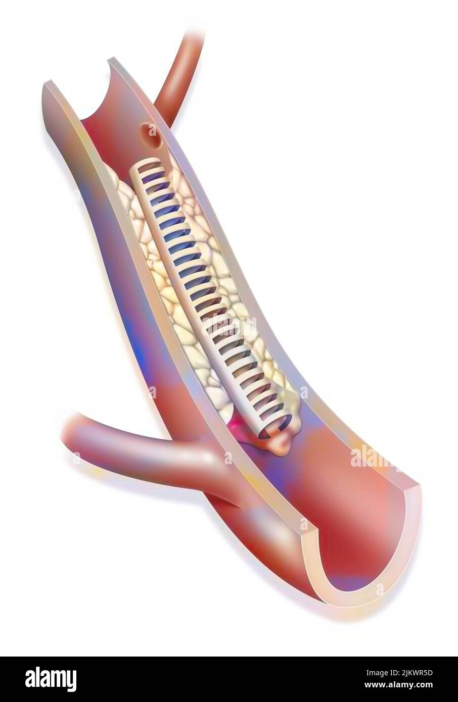 Angioplastie coronarienne par pose de stent, étape 3 : retrait du cathéter. Banque D'Images