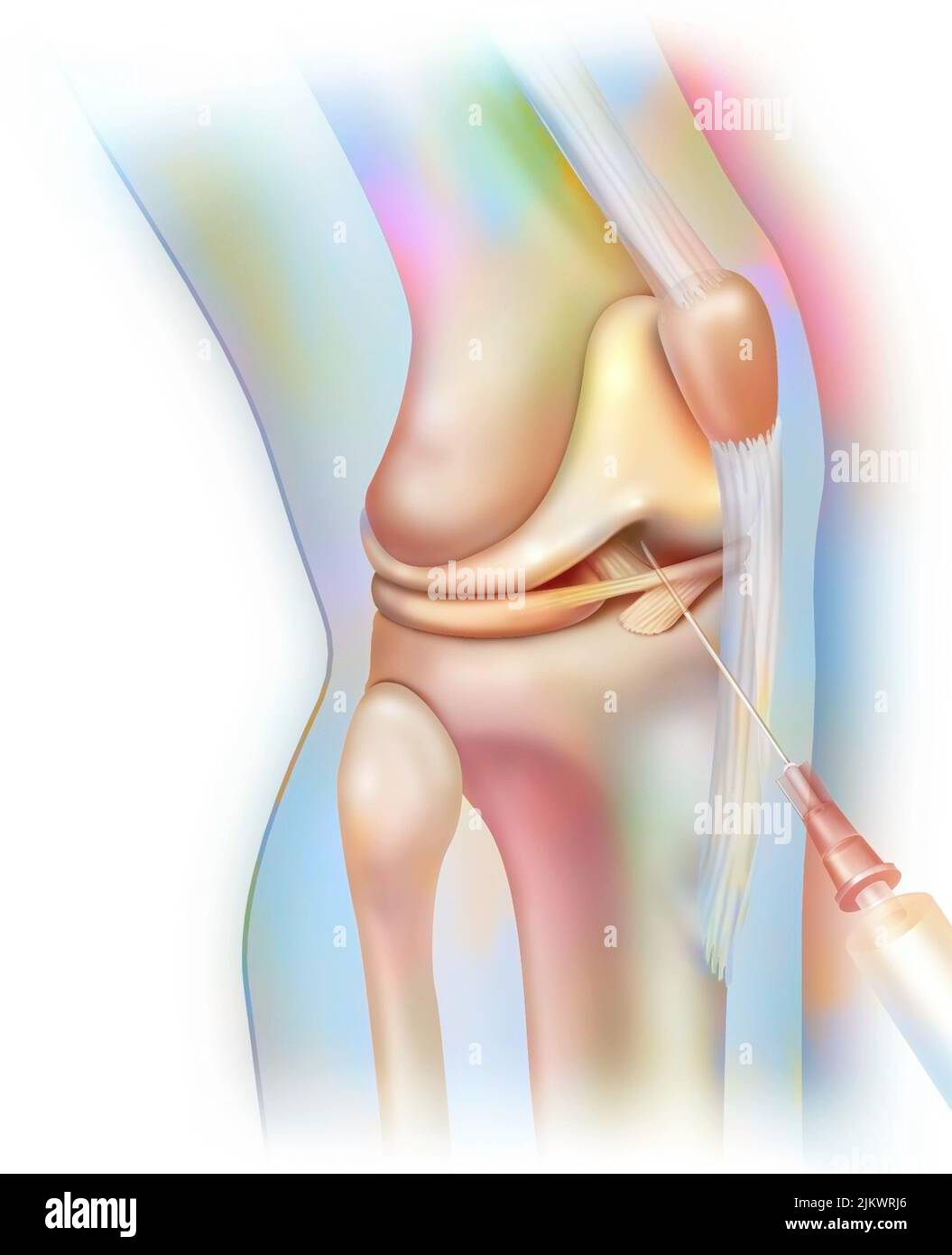 Articulation du genou, arthrographie : injection de produit de contraste pour rendre les structures visibles sur la radio. Banque D'Images