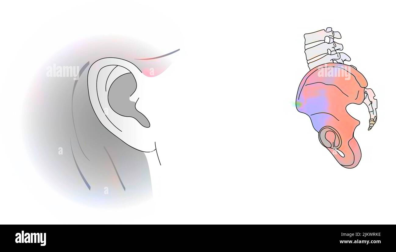 Analogie entre la pinna de l'oreille et l'os iliaque. Banque D'Images
