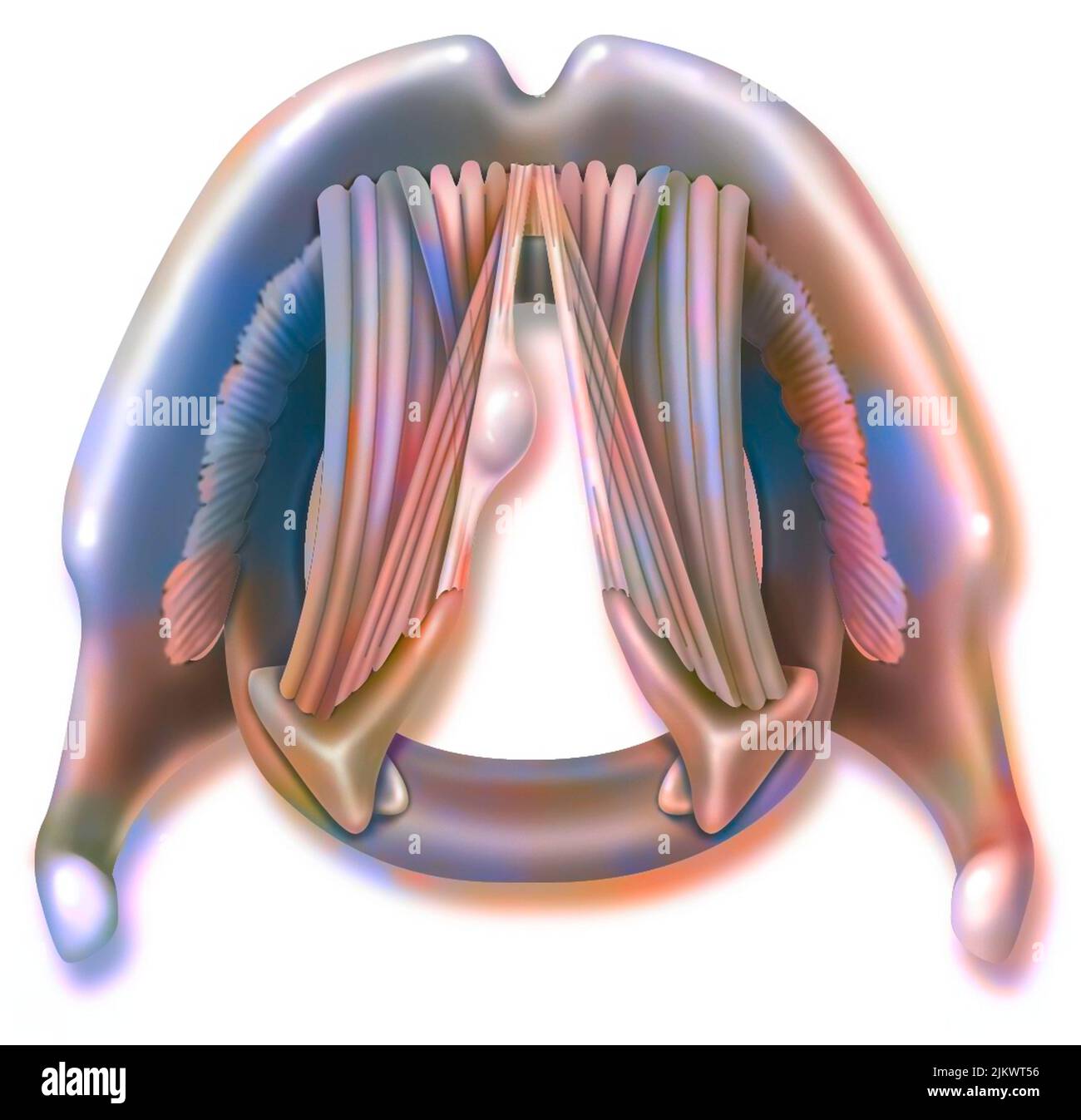 Polype sur une corde vocale avec muscles thyro-aryténoïdes. Banque D'Images